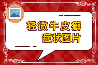 皮肤病（银屑病）治疗方法案例简介：UVB治疗是如何进行的？效果如何？