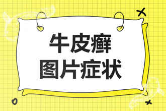 天干物燥，小心“皮癣”！皮肤干燥也是牛皮癣诱发原因！